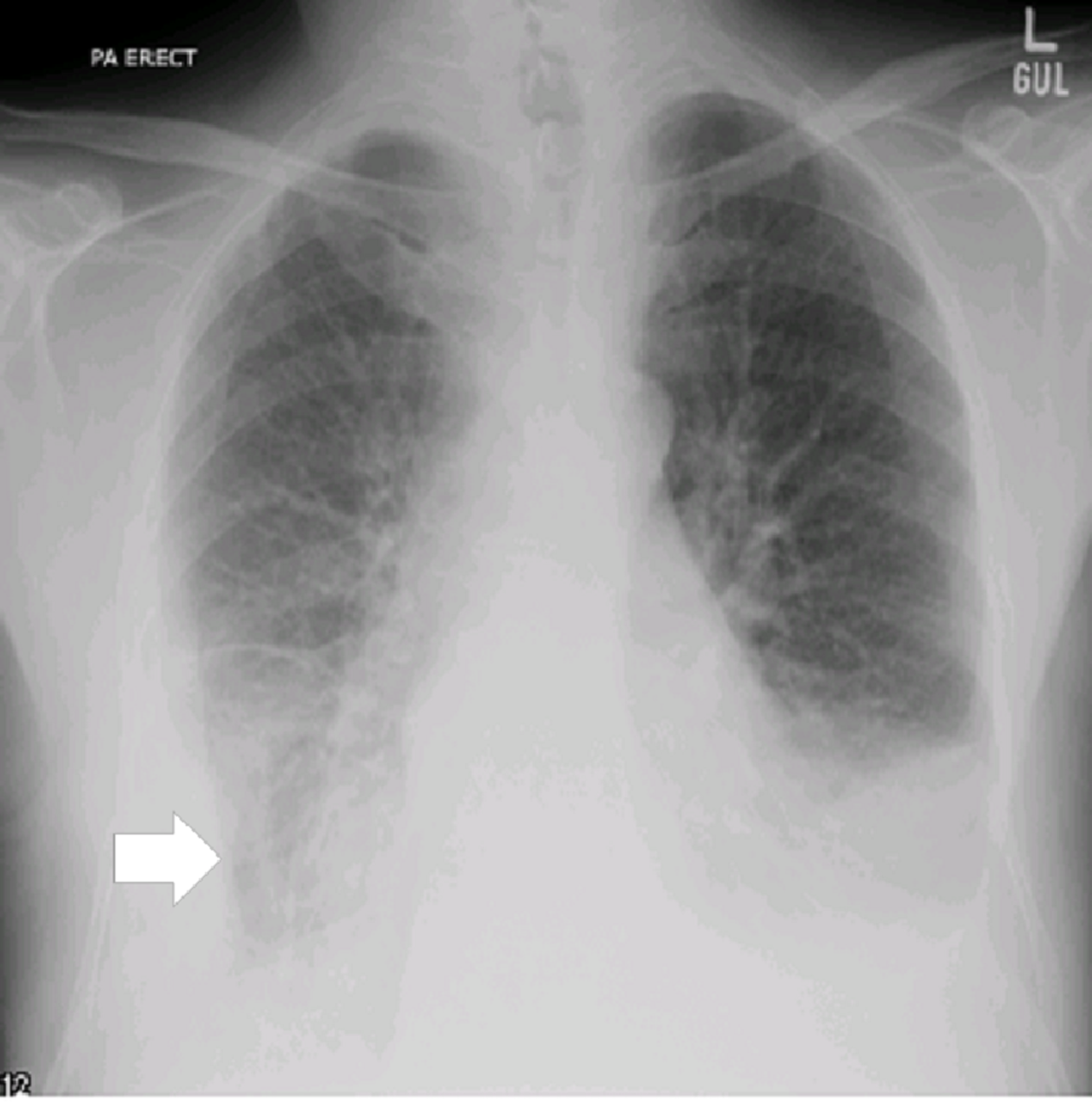 Bilateral Pleural Effusion Chest X Ray : Pleural Effusion Concise ...