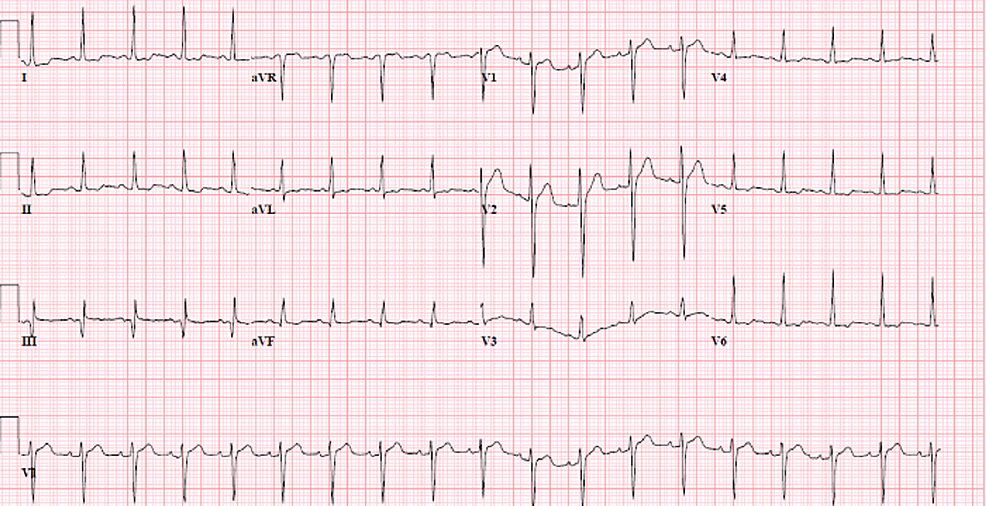 Cureus | Acute Myopericarditis in the Setting of Crohn’s Colitis ...