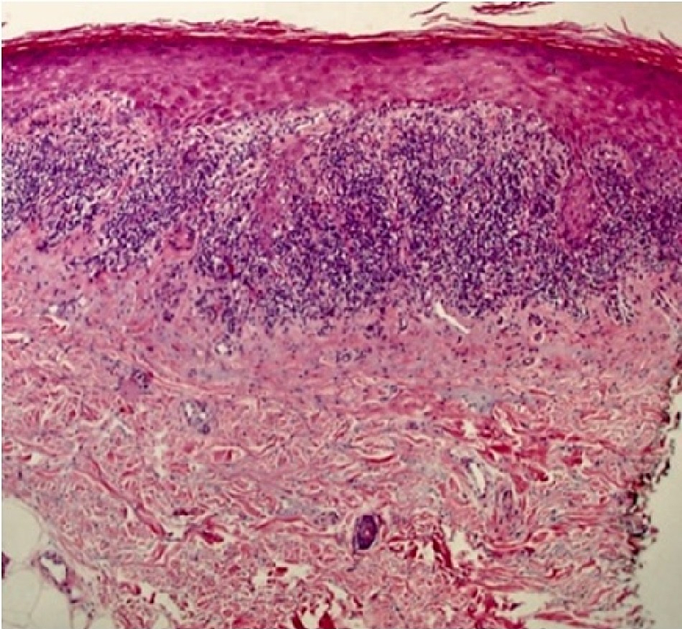 Cureus Zosteriform Lichen Planus on the Trunk A Case Report of a