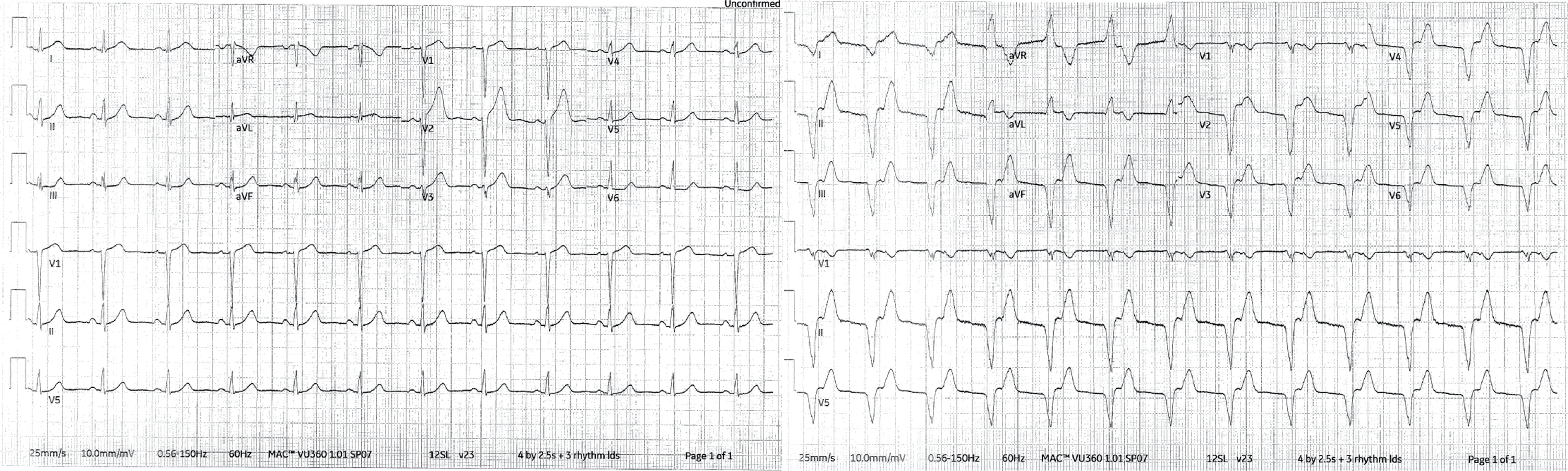 Cureus | Spontaneous Coronary Artery Dissection in the Setting of COVID-19  Pandemic-Related Stressors: A Case Report | Article