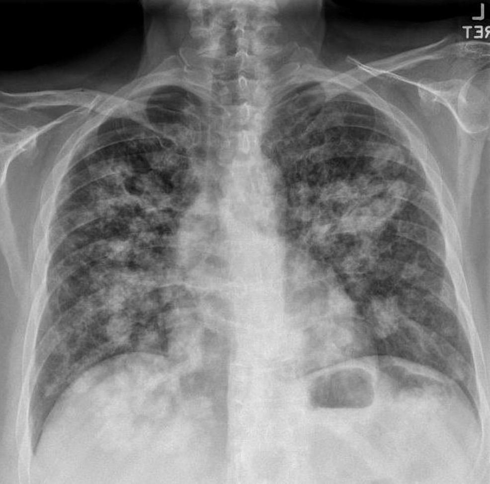 Cureus | Endobronchial Metastasis From Endometrial Carcinoma: A Case ...