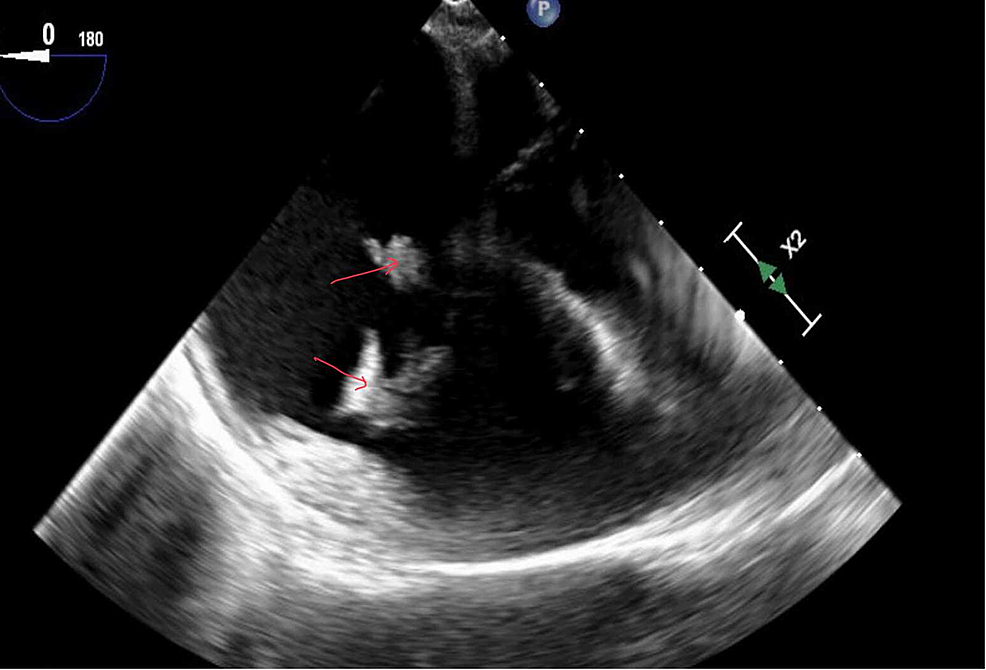 Cureus | A Novel Technique Debulking Vegetations in Tricuspid ...