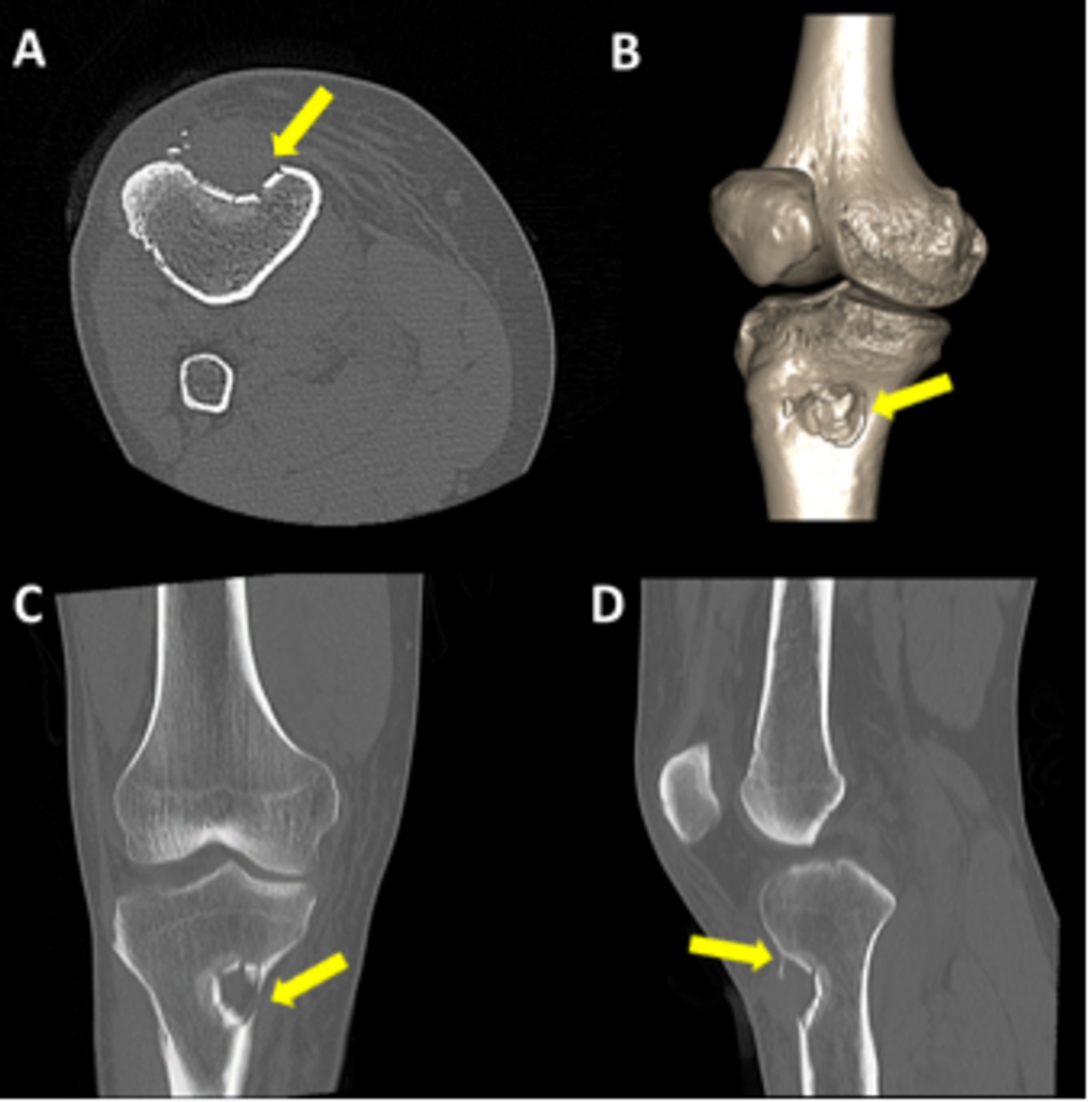 Cureus | Report of a Rare Case of Focal Depressed Fracture of the Tibia ...