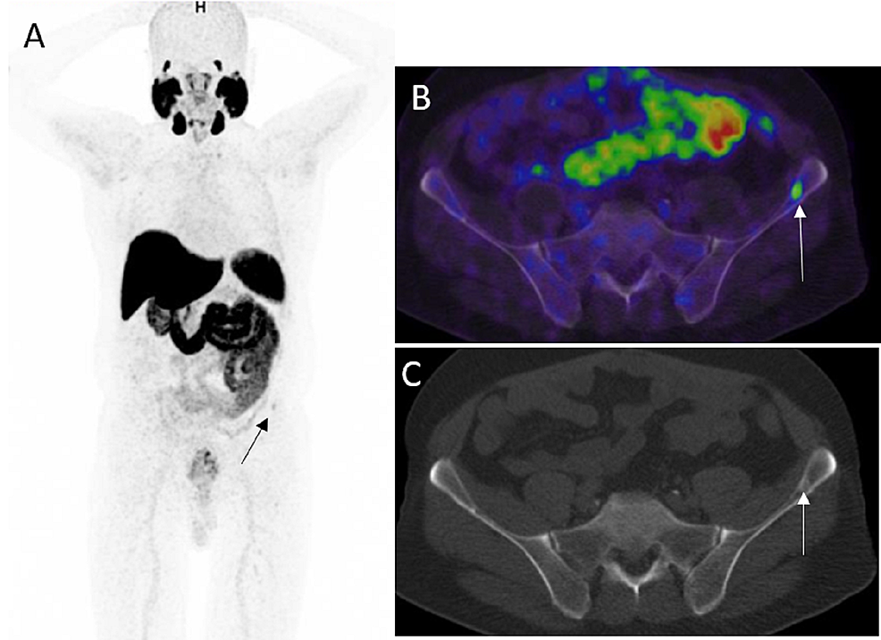 Cureus | Gallium-68 Prostate-Specific Membrane Antigen Positron ...