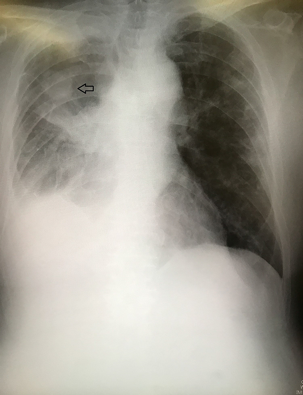 CXR-showing-the-right-lung-adenocarcinoma-and-pleural-effusion-due-to-dissemination