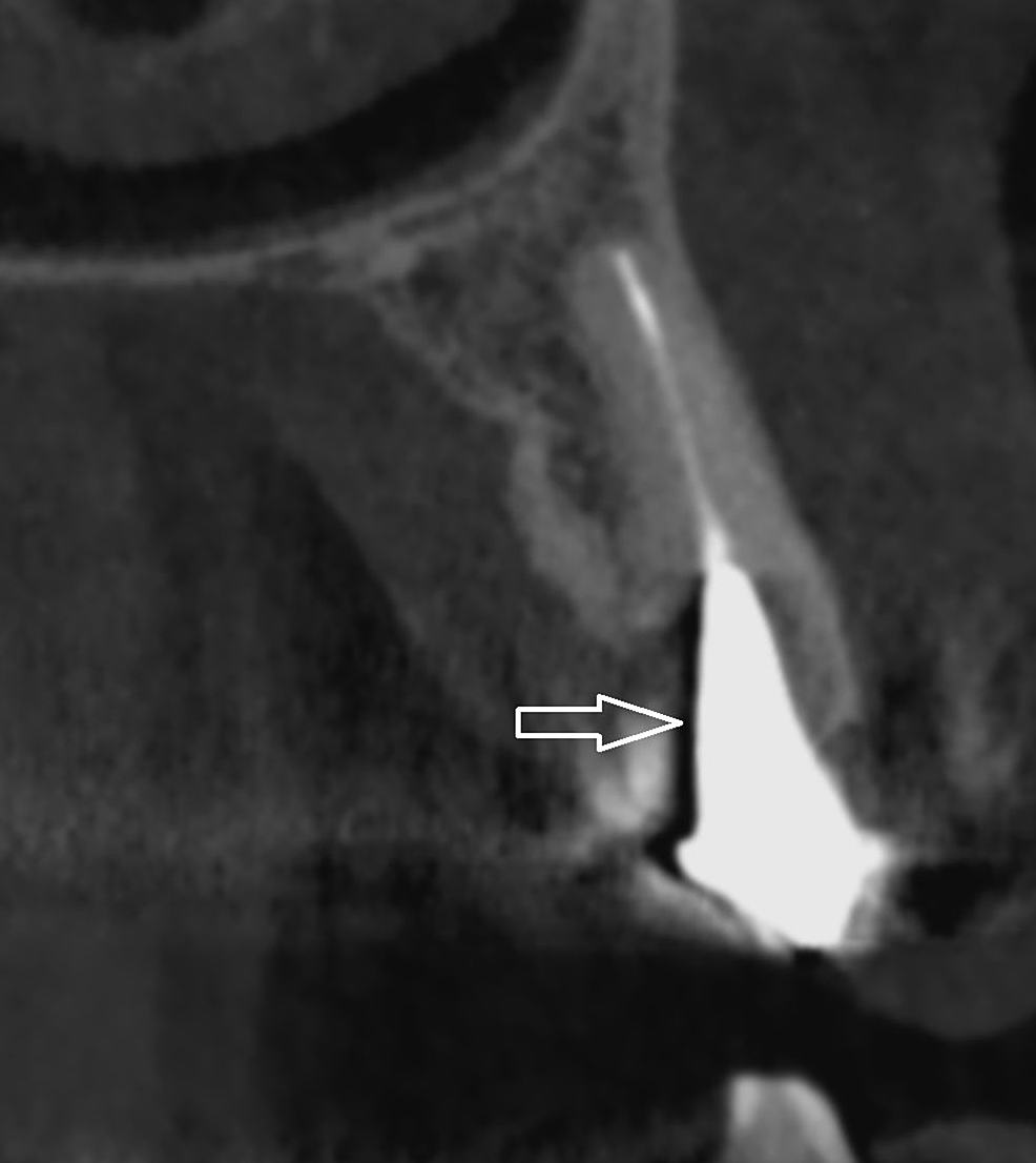 cureus-the-impact-of-cone-beam-computed-tomography-exposure