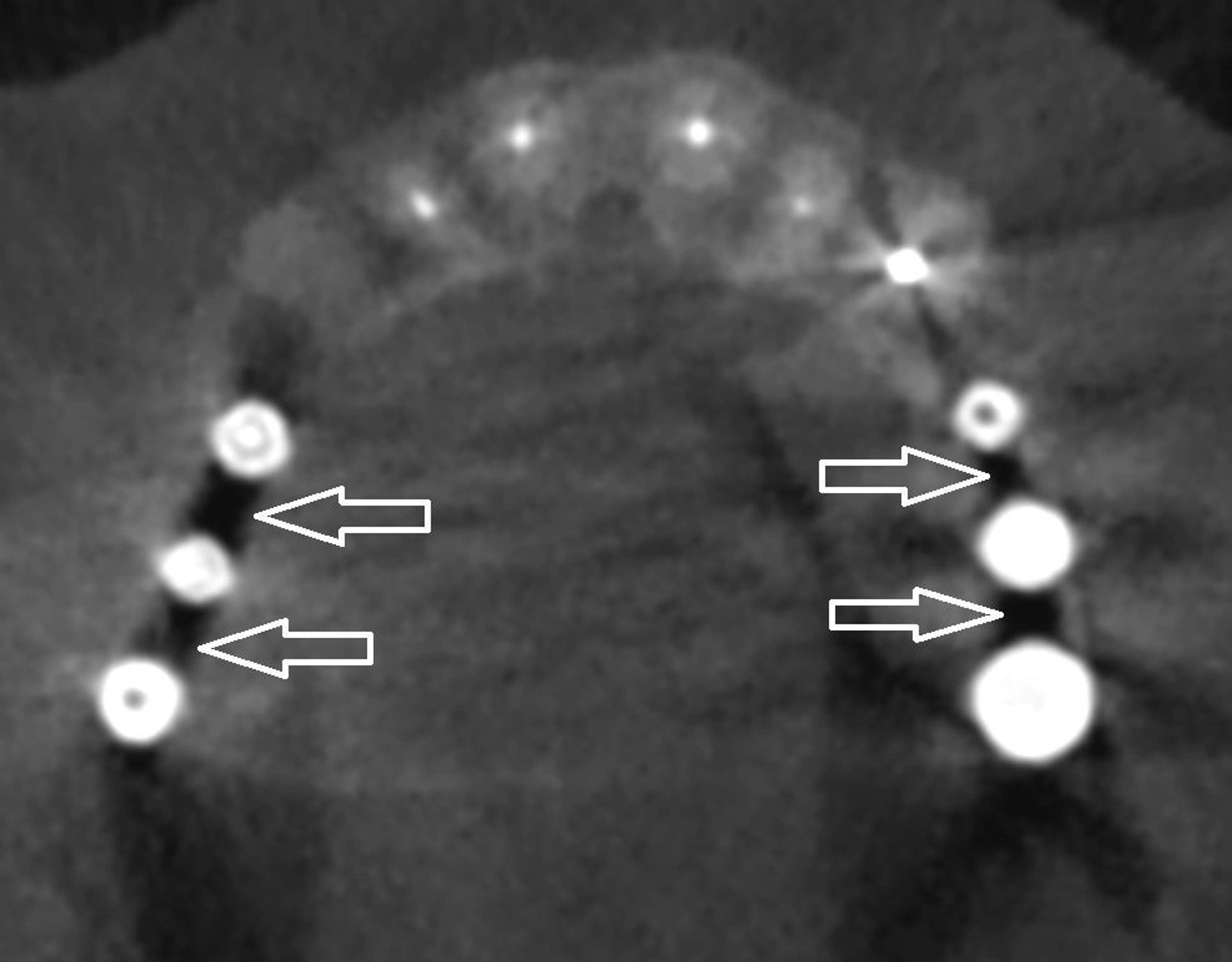 Beam Hardening Artefact Cbct The Best Picture Of Beam