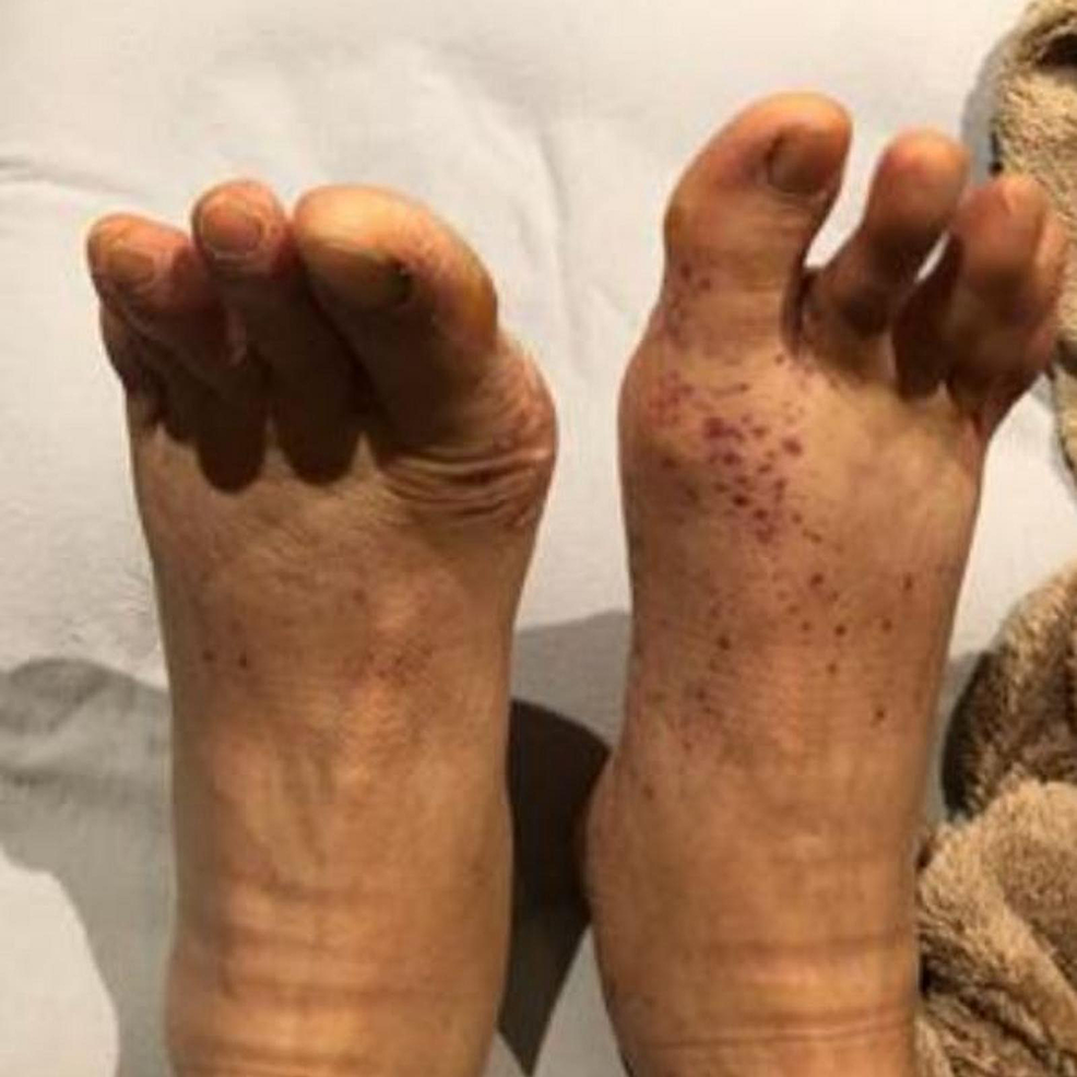 Erythematous-maculopapular-palpable-purpuric-lesions-on-bilateral-feet