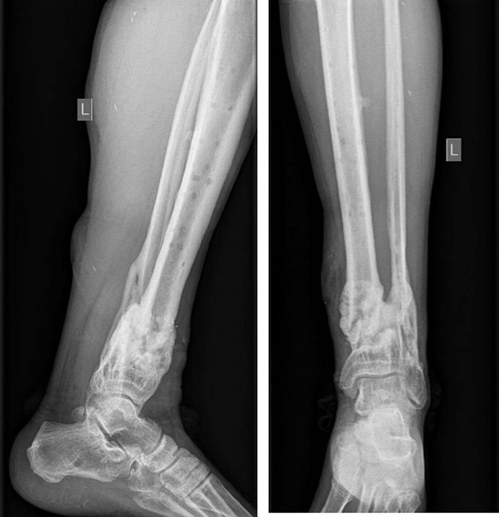 Cureus | A Case of Reconstruction of an Open Tibial Fracture (Gustilo ...