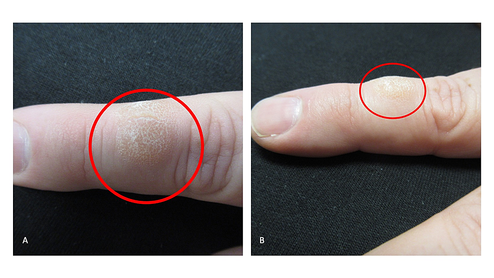 Skin-biting-resulting-in-a-nodule-on-the-dorsal-left-second-digit