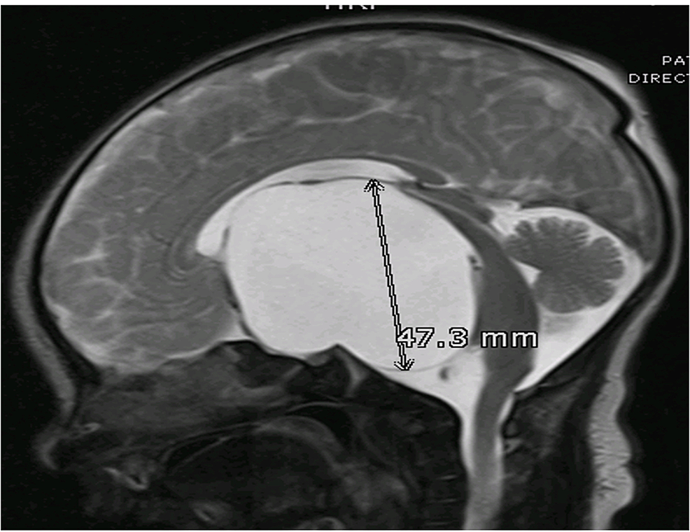 MRI-T2WI,-Sagittal-Section