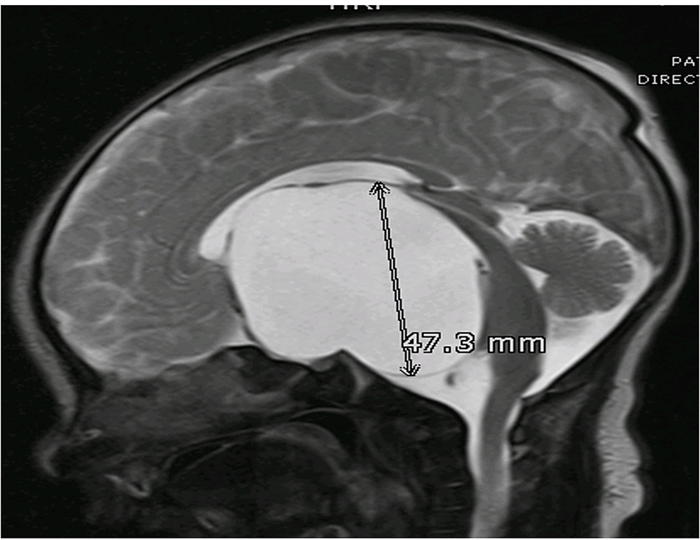 Arachnoid Cyst Size Chart