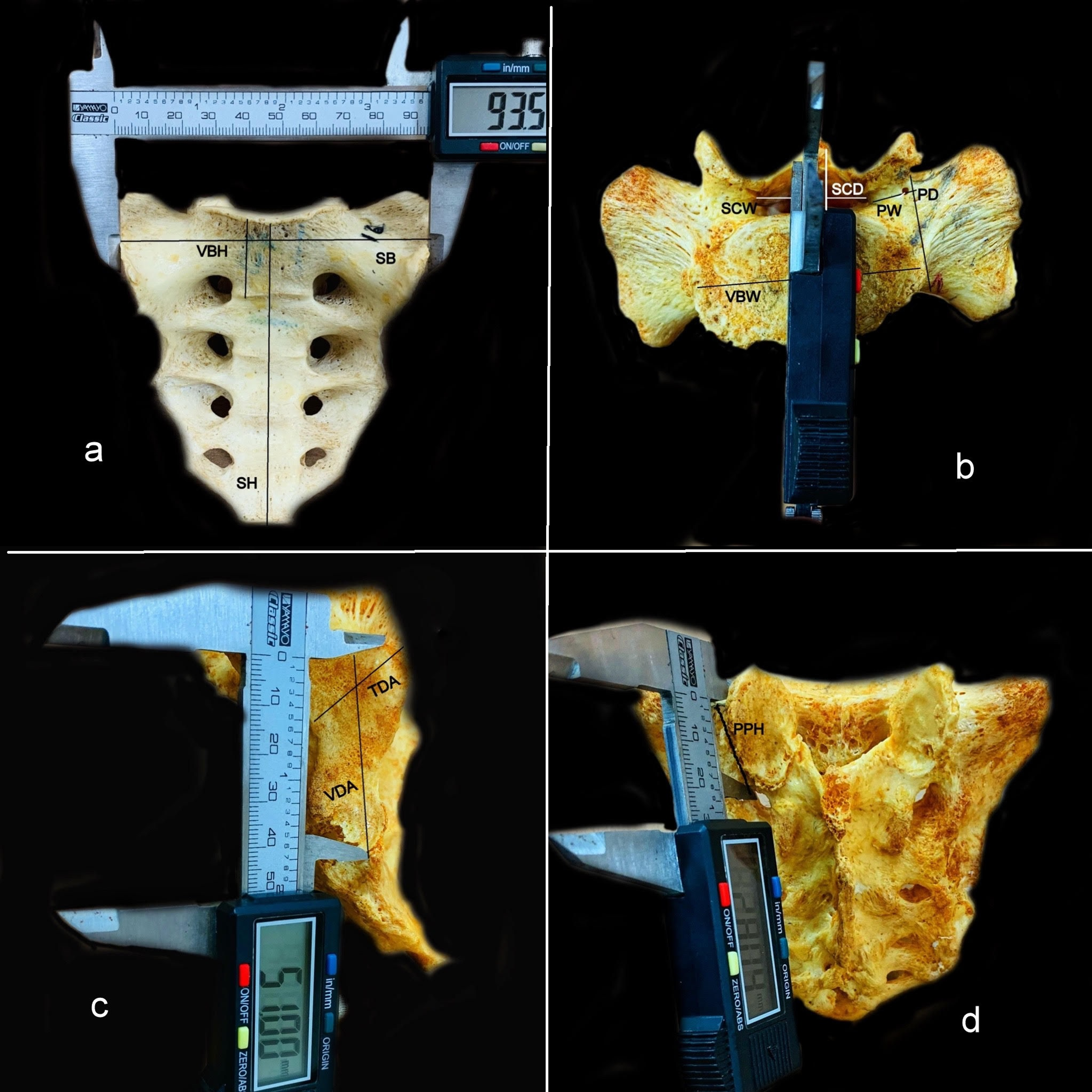 sacral canal contents