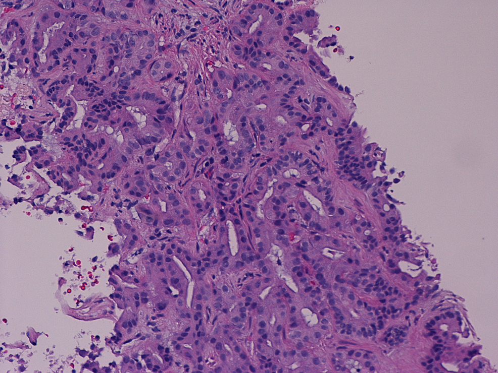 Intrahepatic-cholangiocarcinoma,-moderately-differentiated,-with-residual-gland-formation-showing-foci-of-architectural-irregularity-and-gland-fusion-(Hematoxylin/Eosin-stain,-400X)