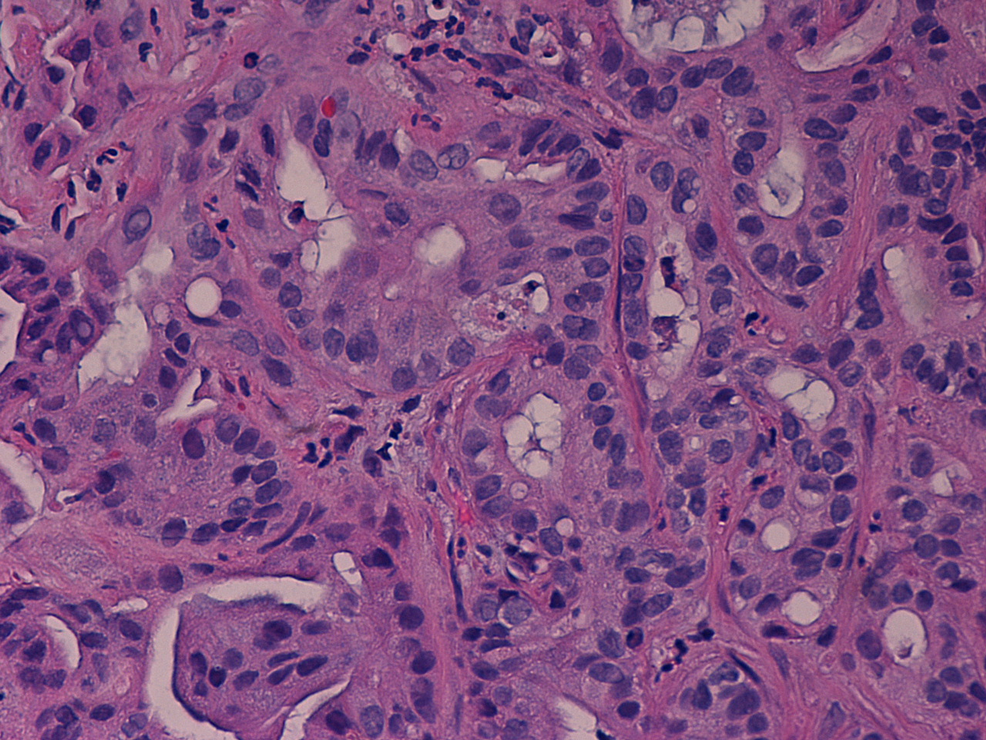 Intrahepatic-cholangiocarcinoma,-moderately-differentiated,-showing-increased-N/C-ratio,-hyperchromatic-nuclei,-necrosis,-mitotic-figures,-and-nuclear-pseudoinclusions-(Hematoxylin/Eosin-stain,-600X)