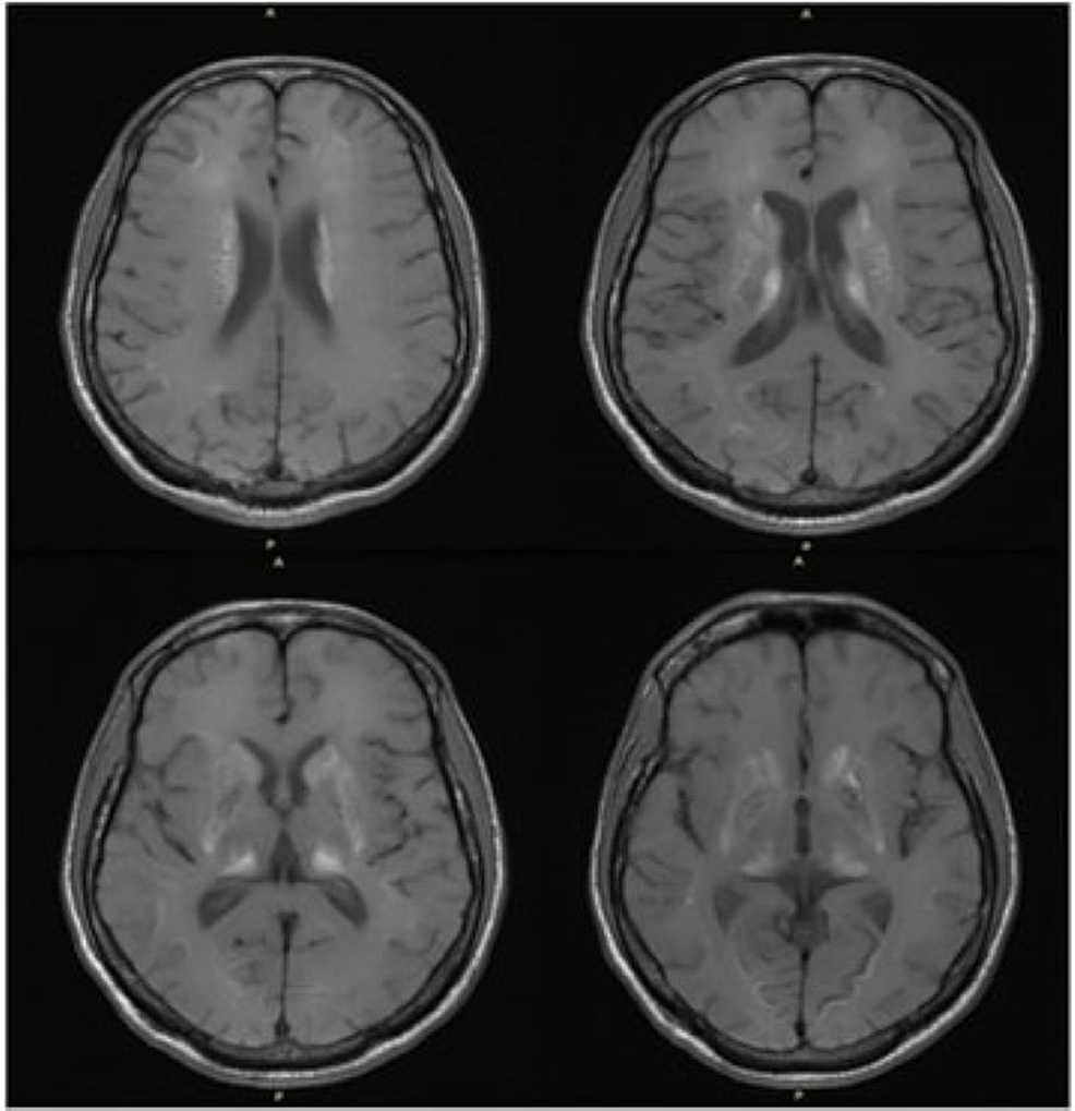 Young Male With Seizure Disorder and Intracranial Calcification: A Case ...