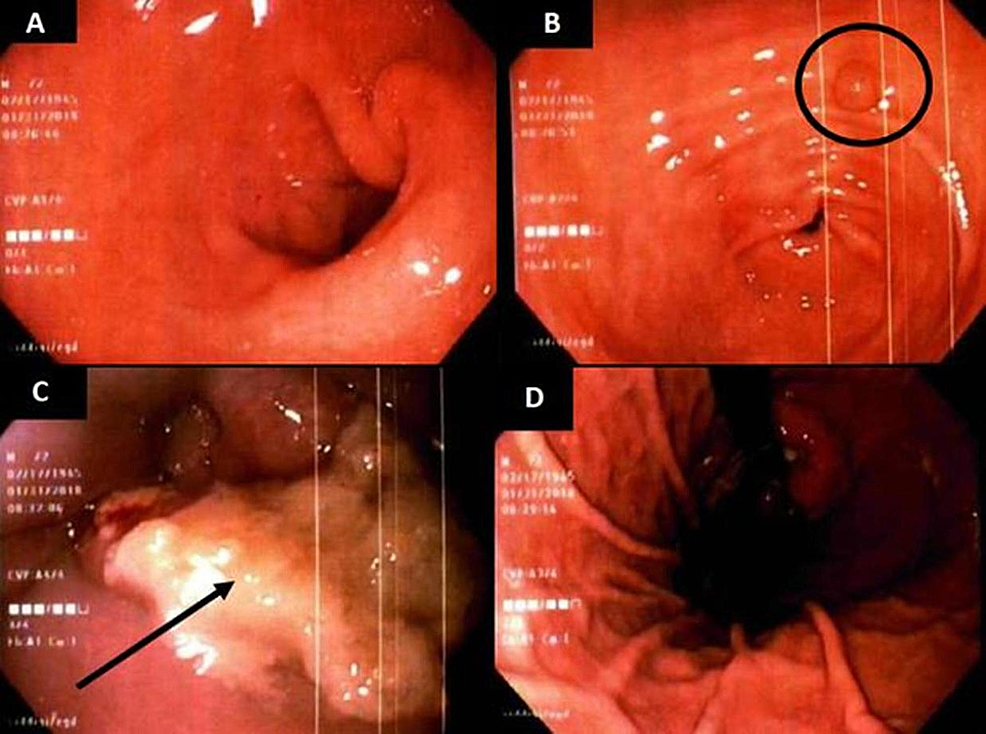 EGD-imaging-of-the-duodenum-(A),-antrum-with-gastric-polyp-shown-with-circle-(B),-distal-esophageal-mass-with-ulceration-shown-with-arrow-(C),-and-fundal-view-(D).