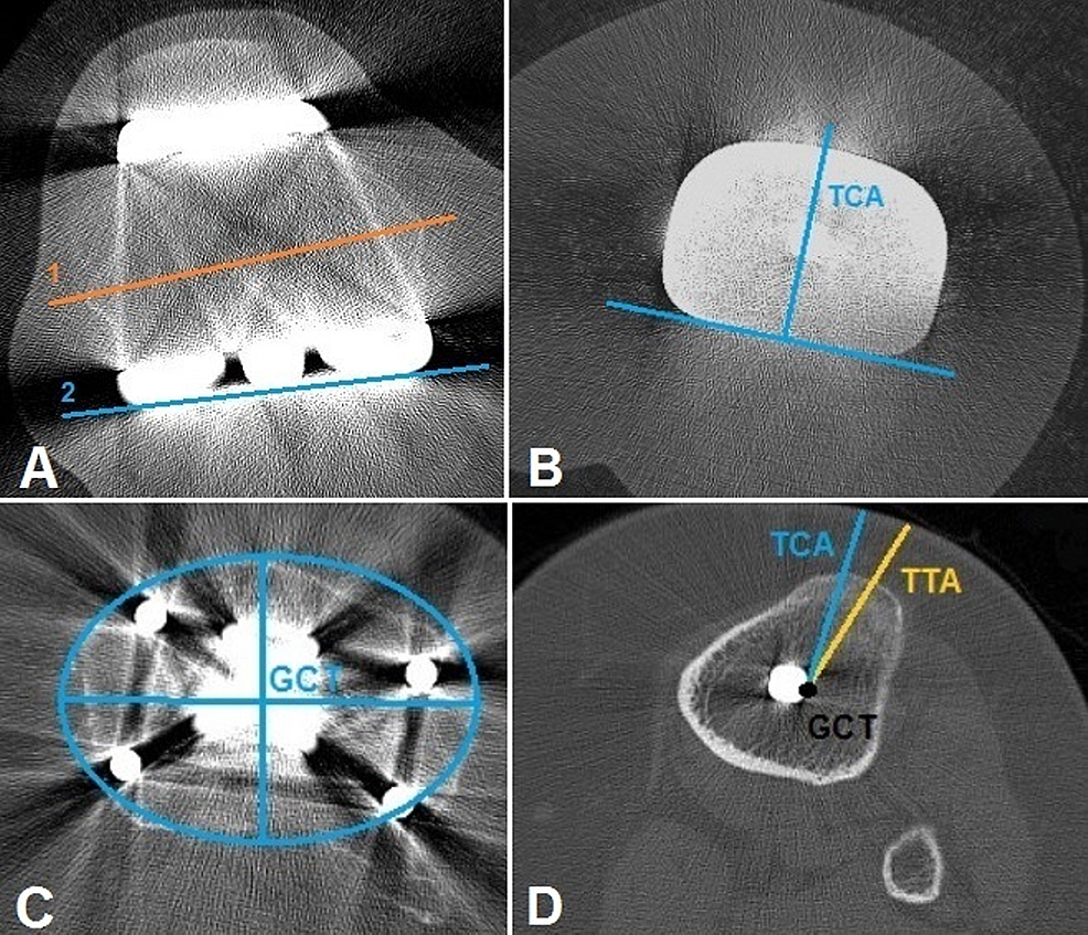 Cureus The Influence of Component Rotational Malalignment on Early