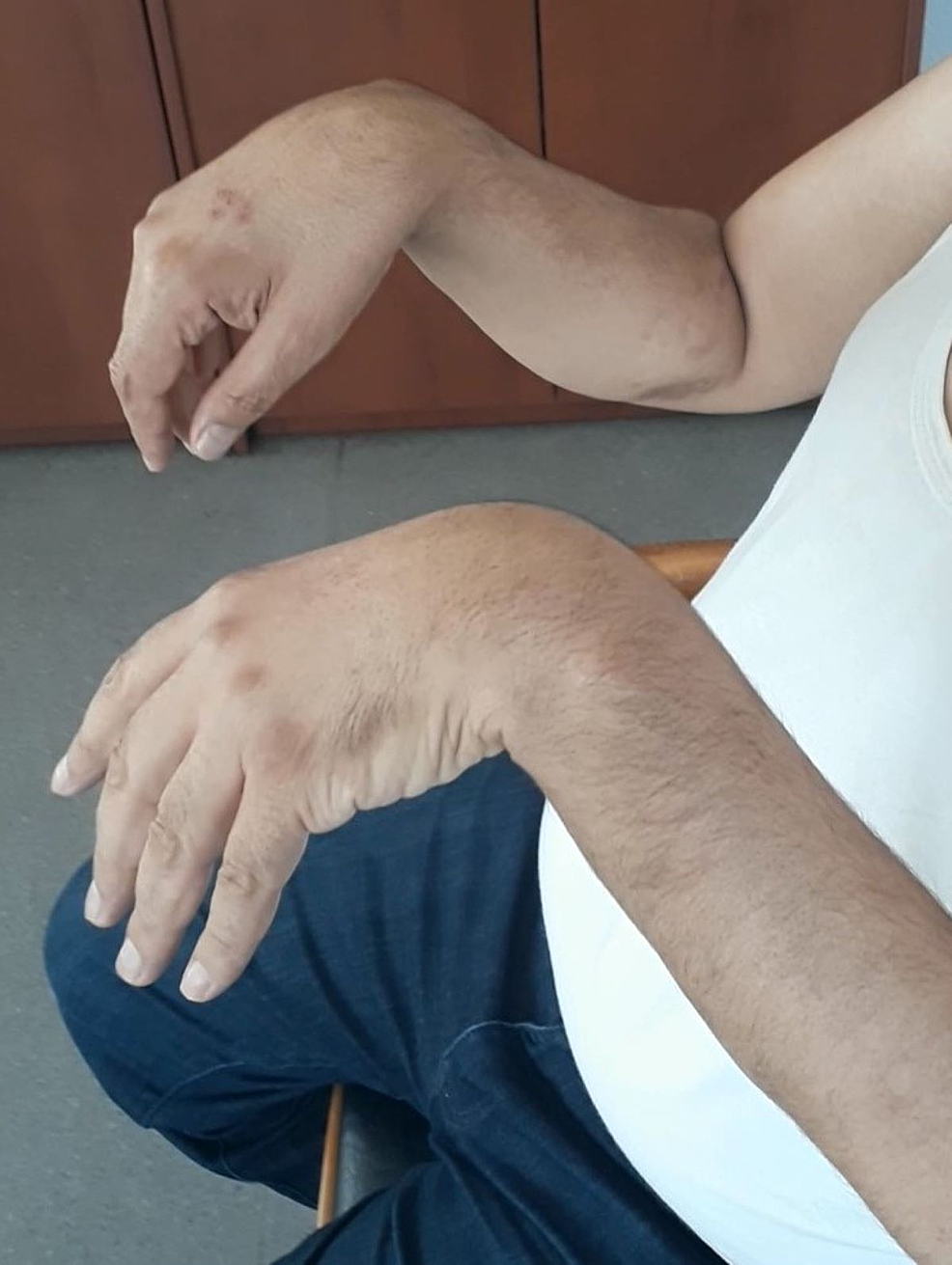 cureus-bilateral-wrist-drop-caused-by-non-invasive-continuous