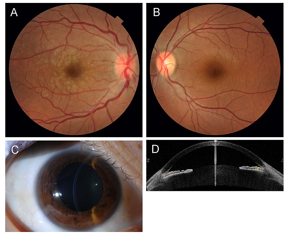Medical Concepts: Acute Angle Closure Glaucoma - CanadiEM