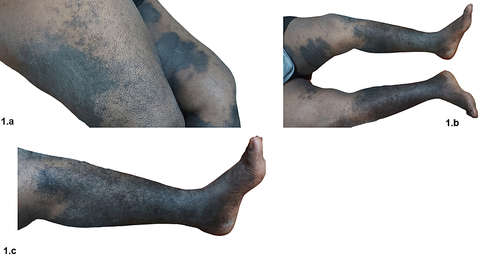 Large,-bilateral,-irregularly-bordered-hyperpigmented-plaques-with-hypertrichosis-and-induration,-over-the-medial-and-posterior-aspect-of-the-thighs-(a),-anterior,-medial,-and-posterior-aspects-of-the-legs-(b),-with-knee-and-foot-sparing-(b,-c)