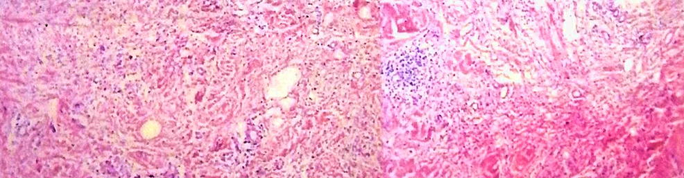 Punch-skin-biopsies-showing-dermal-fibrosis,-diffuse-interstitial-of-lymphocytes,-histiocytes,-and-plasma-cells-with-lymphoid-aggregates-and-proliferated-thick-walled-blood-vessels