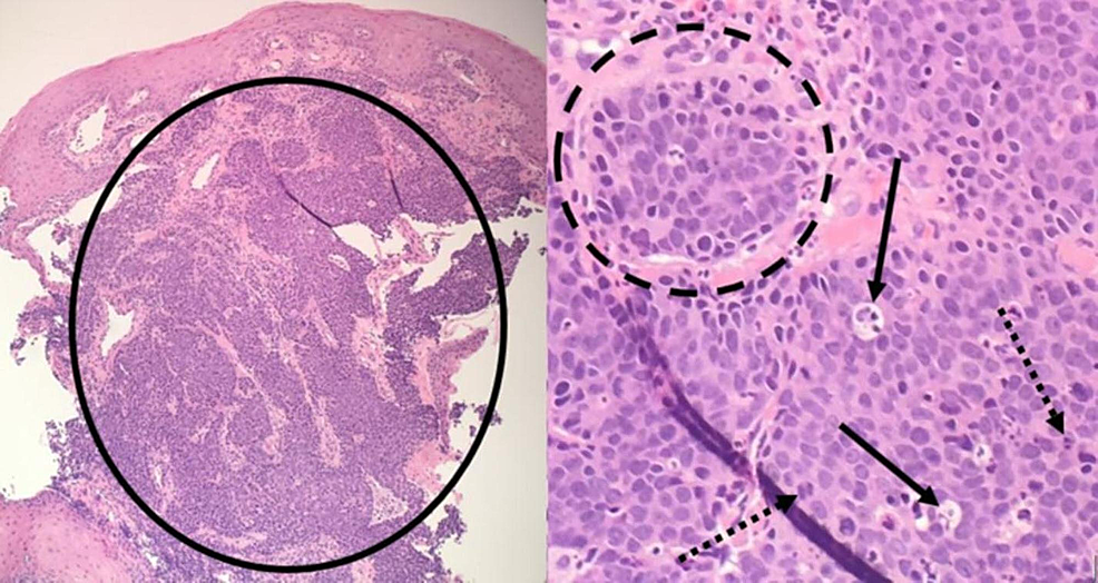 Biopsy-specimen-from-the-proximal-esophageal-mass-(Hematoxylin-and-Eosin-stain)-showing-basophilic-cells-with-variable-size-and-shape-representing-the-tumor-cells-in-an-organoid-pattern-(solid-circle)-beneath-a-layer-of-non-keratinized,-stratified-squamous-epithelium.-The-tumor-cells-have-hyperchromatic-nuclei-and-arrange-into-nests-(dashed-circle).-Mitotic-figures-(dashed-arrows)-and-apoptotic-bodies-(solid-arrows)-are-found-throughout.
