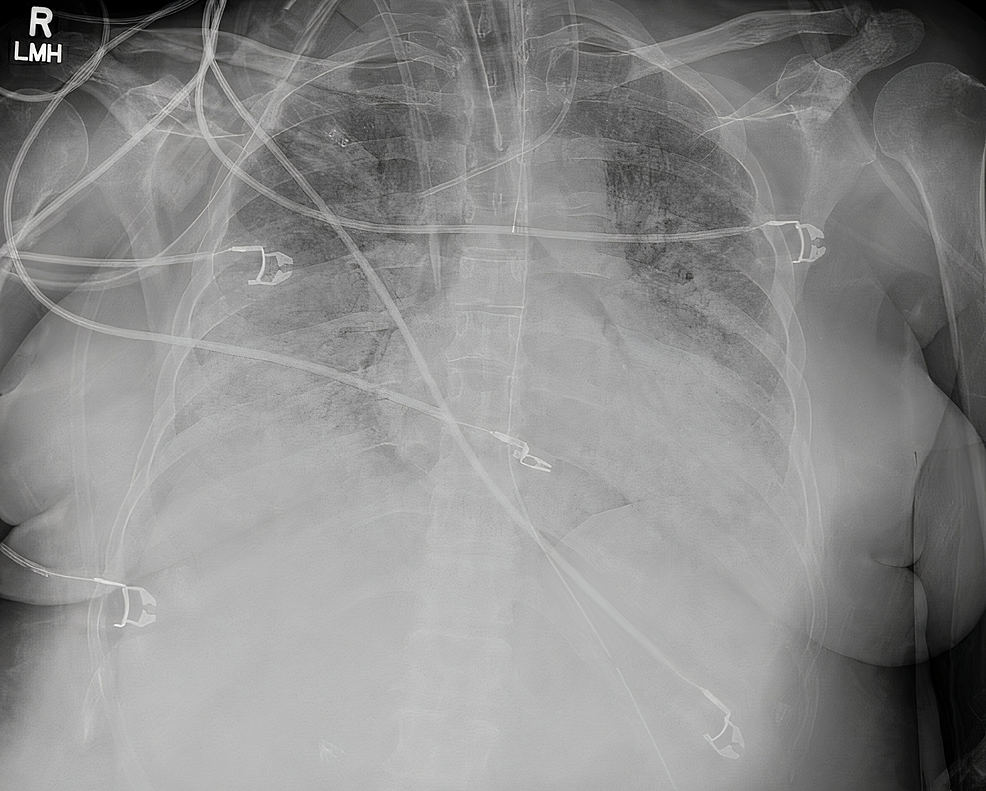 Initial-chest-x-ray-obtained-at-tertiary-care-facility-displaying-bi-basilar-opacities-prominent-within-right-lung-fields.