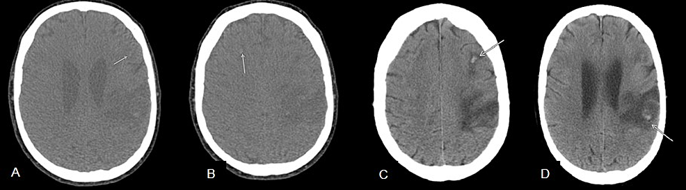 A-D.-Initial-CT-head-obtained-at-tertiary-care-facility-displaying-multiple-foci-hemorrhages-within-bilateral-frontal-and-right-temporal-lobe.-Arrows-indicate-multiple-foci-of-hemorrhage.
