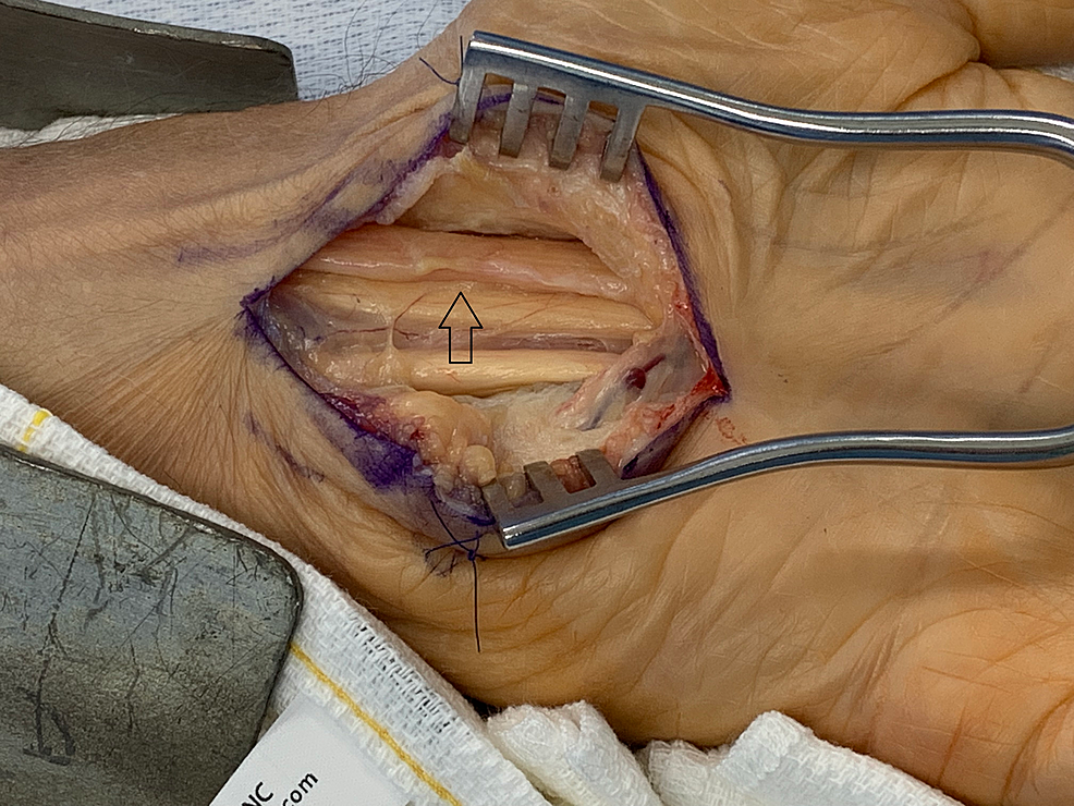 Cureus, Exoscope for Upper Extremity Peripheral Nerve Surgery: Revision Carpal  Tunnel Release With Epineurolysis and Hypothenar Fat Flap
