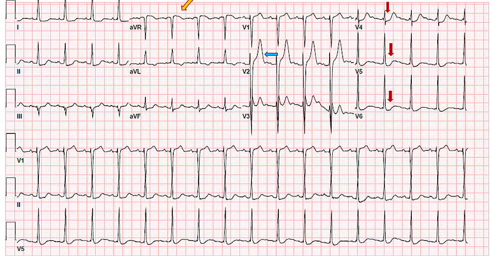 Electrocardiogram:-Red-arrows-pointing-towards-ST-depression-in-V4,-V5,-and-V6:-Blue-arrow-showing-tall-T-wave;-Yellow-arrow-showing-aVR-elevation-