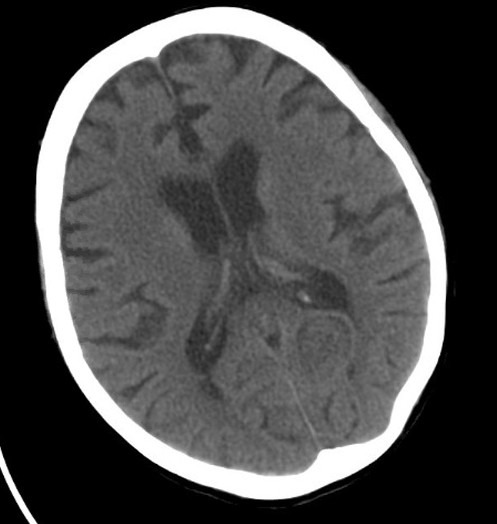 CT-scan-of-the-head:-No-acute-intracranial-abnormality