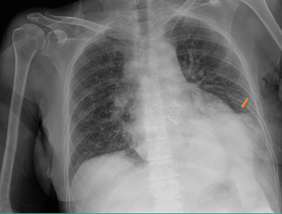 Chest-x-ray-Anteroposterior-view---Left-basilar-opacity-and-elevation-of-the-left-diaphragm-(indicated-by-the-arrow)