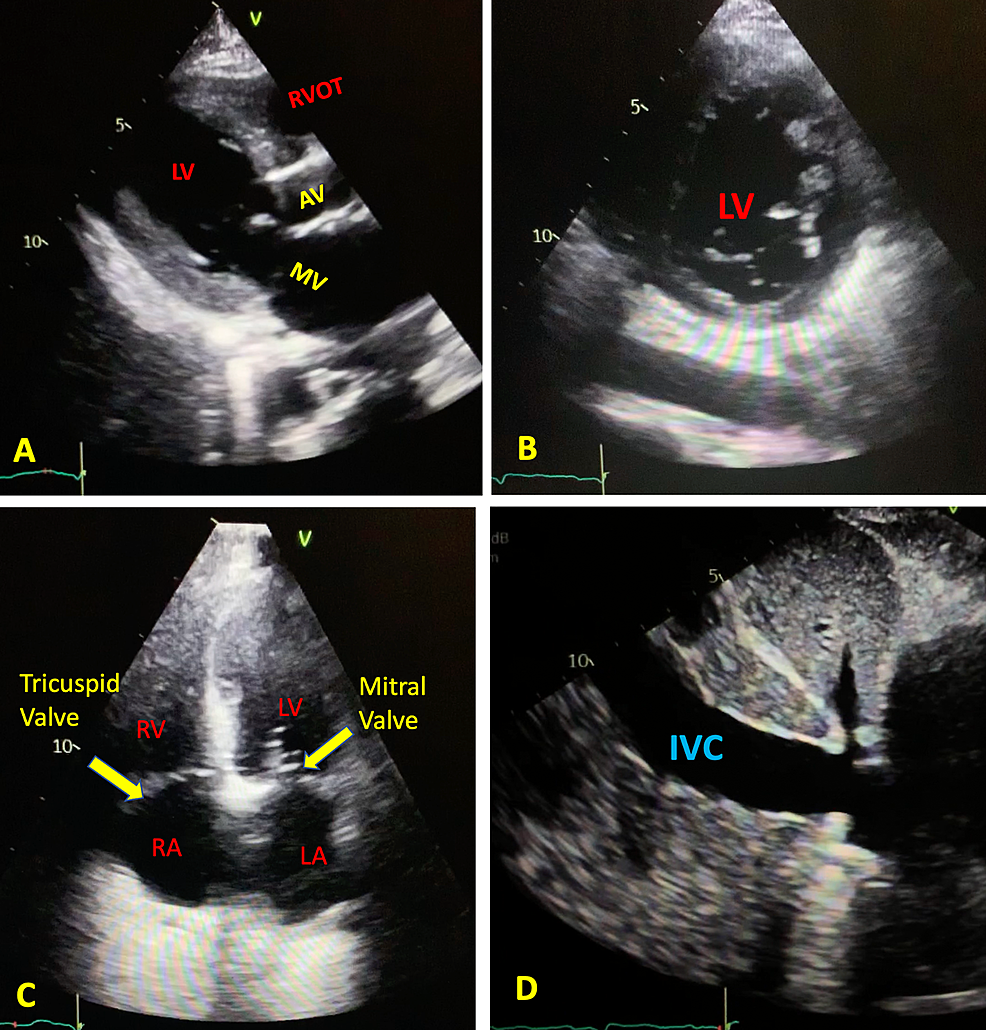 Cardiac-Echo-Cardiogram-2D---[A]-Parasternal-long-axis-view---LV-[B]-Parasternal-short-axis-view-[C]-Four-Chamber-View-[D]-Subcostal-view