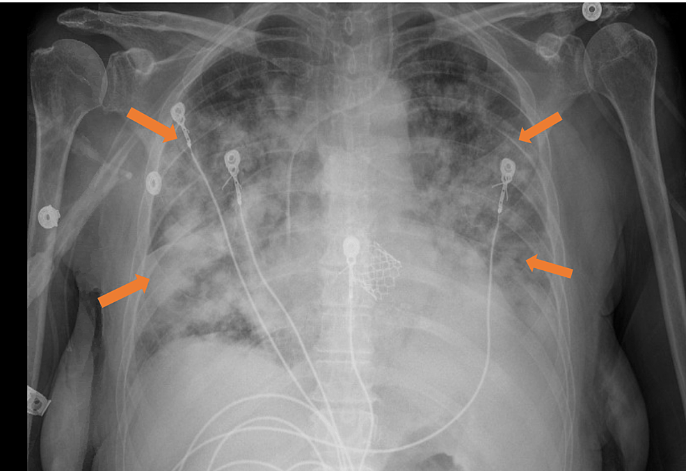 Chest-x-ray-7-hours-post-transfusion---Bilateral-diffuse-alveolar-infiltrates-(indicated-by-all-the-arrows)