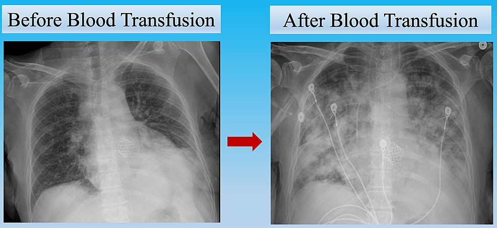 A-comparison-of-chest-X-ray:-Pre--and-Post--transfusion