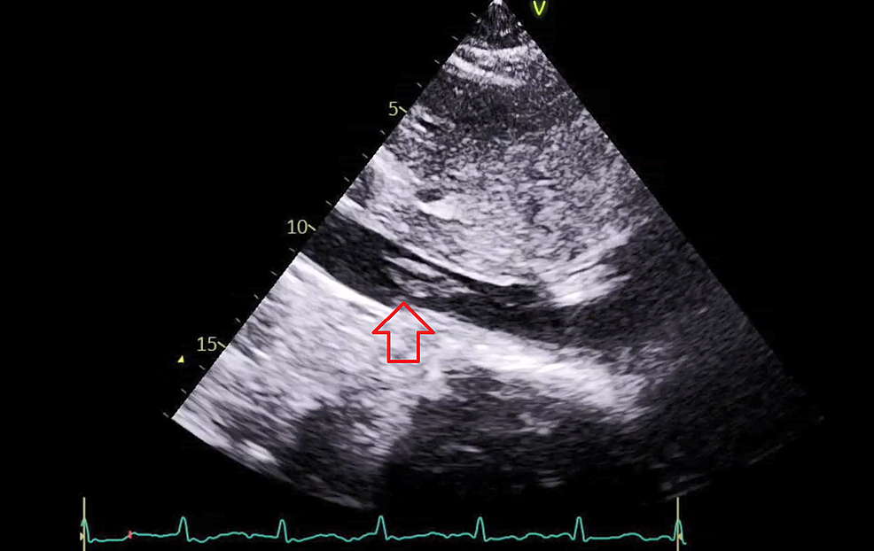 Amniotic Fluid Embolism (AFE): Causes, Symptoms & Treatment