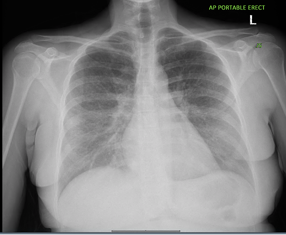 Chest-X-Ray-showing-an-ill-defined,-generalized,-hazy-reticulonodular-pattern-of-the-lungs