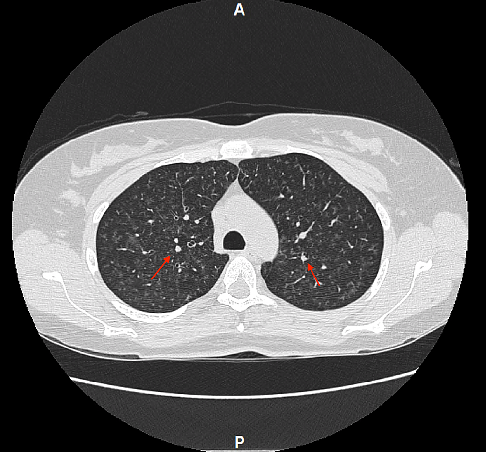 Cureus A Case of Ecigarette or Vaping Product UseAssociated Lung