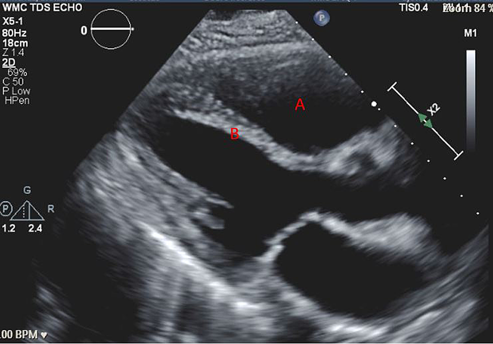 Preoperative-TTE-parasternal-long-axis-view-showing-(A)-dilated-right-ventricle-and-(B)-flattened-intraventricular-septum-as-evidence-of-right-sided-pressure-and-volume-overload.&nbsp;