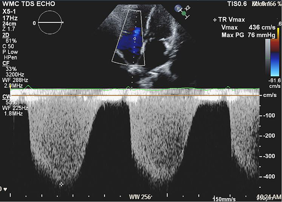 Preoperative-TTE-apical-chamber-view-with-tricuspid-regurgitation-and-dilated-right-ventricle.-Right-ventricular-systolic-pressure-(RVSP)-=-76-mmHg-+-right-atrial-pressure-(RAP).