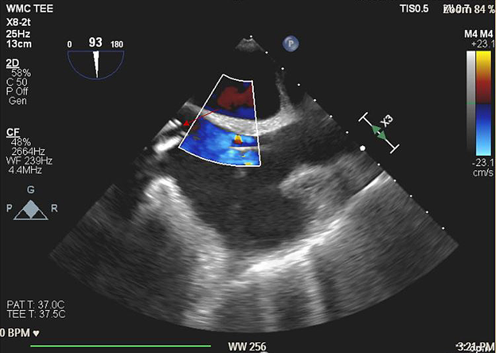 Perioperative-TEE-(mid-esophageal-bicaval-view)-immediately-after-VA-ECMO-femoral-cannulation.-Red-arrow-shows-ECMO-canula-in-the-atriocaval-junction.