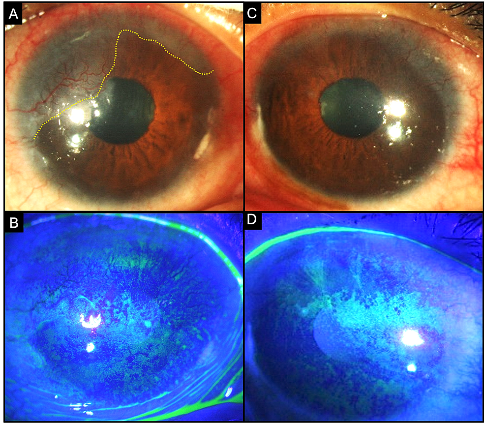 . Pathology and bacteriology [electronic resource]. Ophthalmology; Eye;  Eye; Bacteriology; Ophthalmology; Eye; Bacteriology; Eye. THE CORNEA 559  Tertiary syphilis rarely affects the lids and conjunctiva. Occasionally  gummatous ulcers may form on the