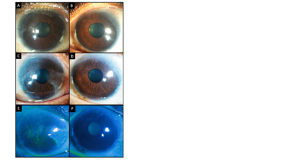 Cureus | Conjunctival Autograft for Bilateral Tarsal Keratinization in ...