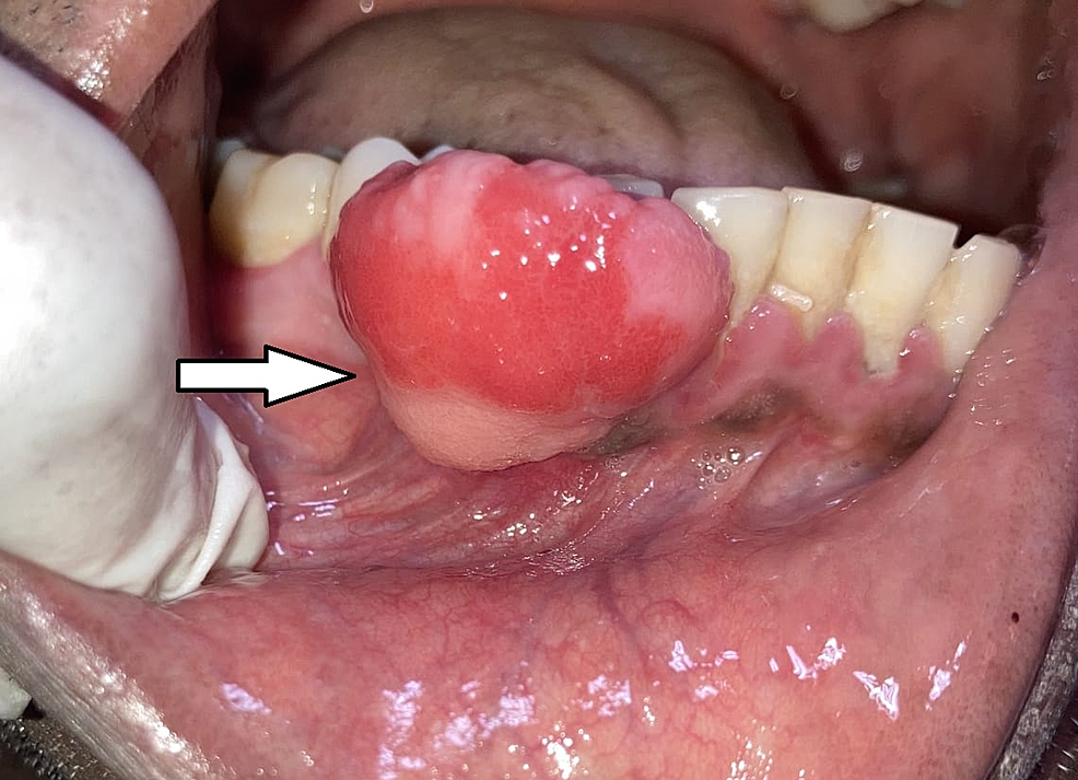 ossifying fibroma oral