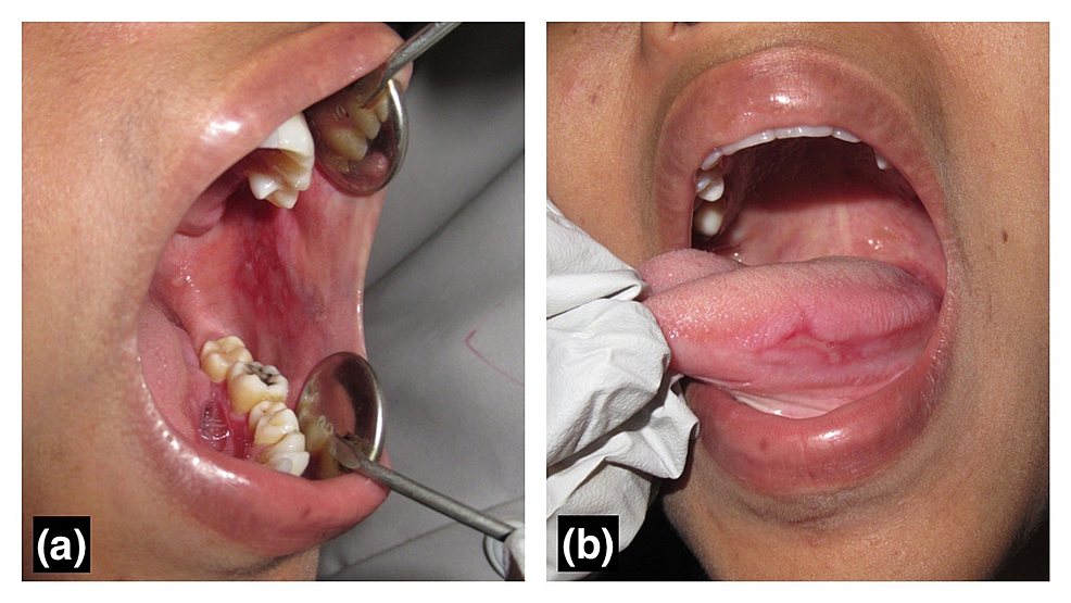 A 7-year retrospective study of biopsied oral lesions in 460