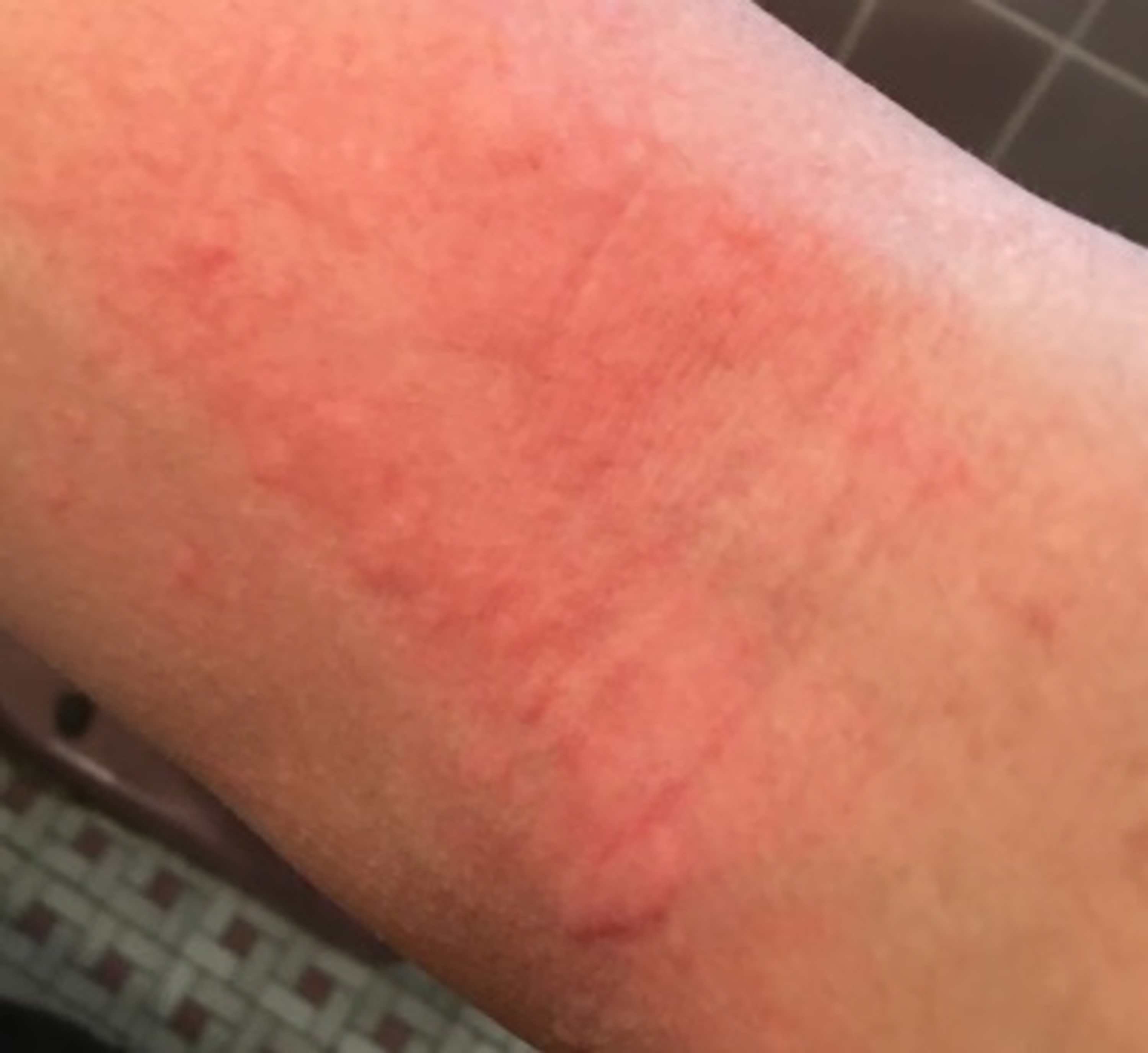 Cureus | Exercise-Induced Urticaria: A Case Report | Article