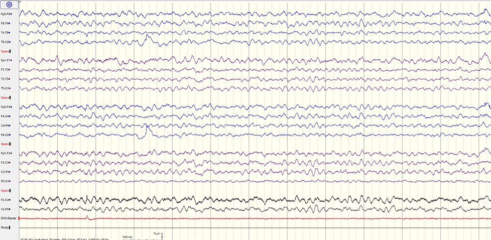 EEG-recording-of-patient-1-showing-the-posterior-background-of-6-Hz,-moderate-diffuse-encephalopathy-without-epileptiform-activity