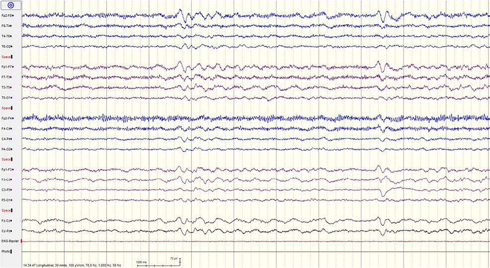 EEG-recording-of-patient-2-showing-posterior-background-of-7-Hz,-mild-diffuse-encephalopathy-without-epileptiform-activity