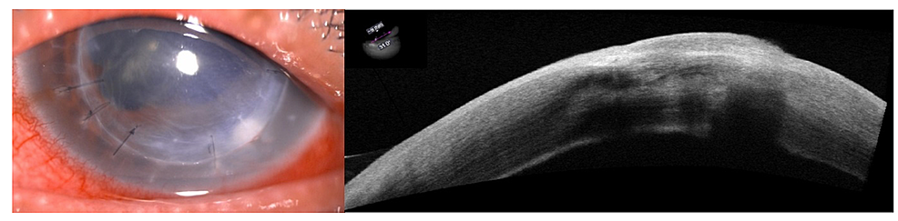Stromal-infiltrate-was-extending-to-the-interface-space-from-the-initial-graft-host-junction,-with-intact-uninvolved-epithelium.
